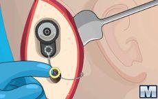 Operate Now: Ear Surgery