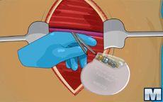 Operate Now: Pacemaker Surgery